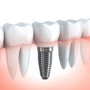 歯を失った時の治療法①インプラント