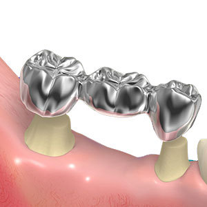 歯を失った時の治療法②ブリッジ